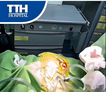 PHẪU THUẬT VÁ MÀNG NHĨ CHO BỆNH NHÂN BỊ RÁCH MÀNG NHĨ DO LẶN DƯỚI NƯỚC